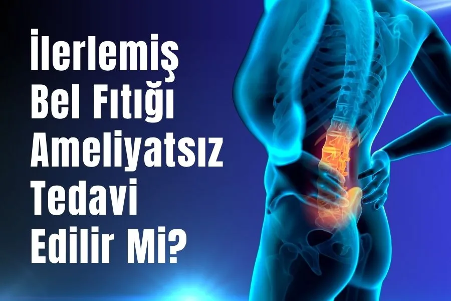 ilerlemiş bel fıtığı ameliyatsız tedavi edilir mi